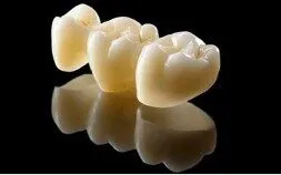 Ceramic dental bridge for tooth replacement at Smilezone Zug, premium dental prosthesis.