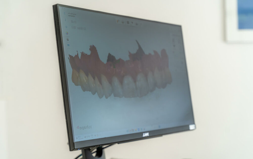 Digitale 3D-Darstellung von Zähnen auf Monitor – Smilezone Zug nutzt moderne Technologie für präzise Zahnfüllungen.