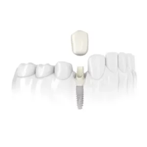 White ceramic implant model inserted in teeth at Smilezone Zug dental practice.