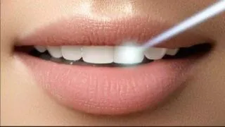 Laser teeth treatment for a bright smile at Smilezone Dental Practice Zug.
