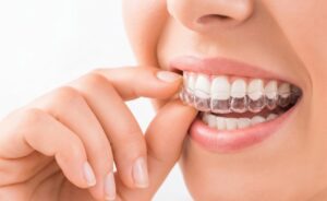 Frau setzt transparente Zahnschiene ein, angeboten von Smilezone Zahnarzt Zug