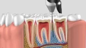 Root canal treatment illustration by a dentist at Smilezone Dental Practice Zug.