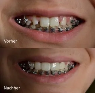 Before and after orthodontics for a beautiful smile at Smilezone Dental Zug.
