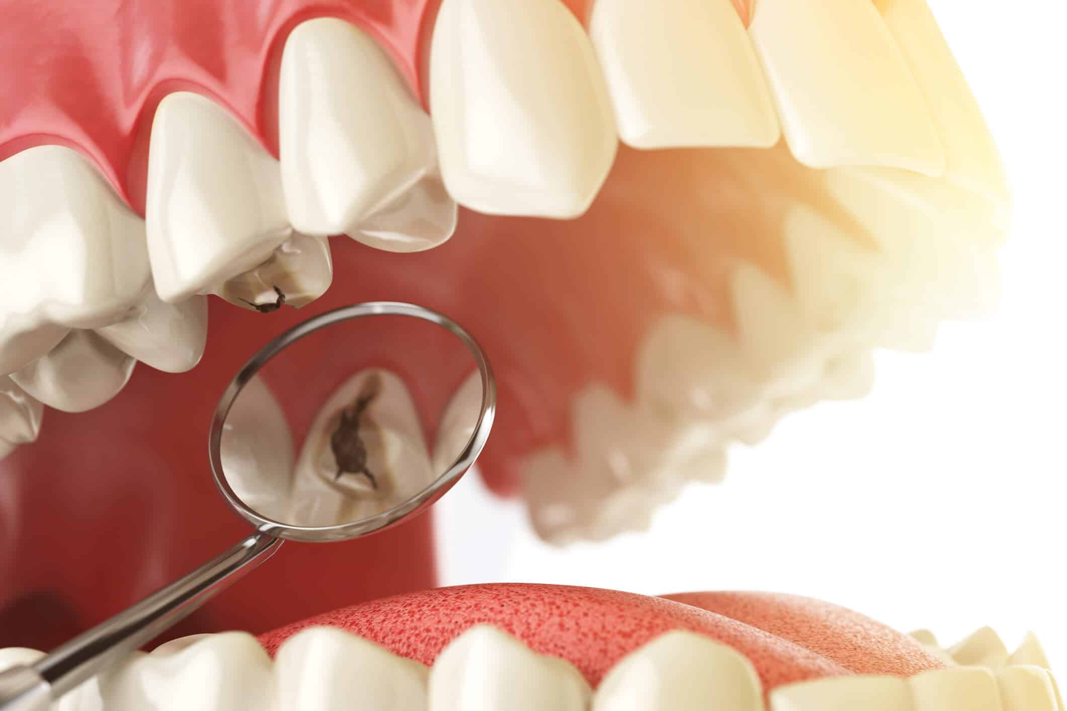 Darstellung einer kariösen Zahnoberfläche vor der Füllung – Smilezone Zug bietet professionelle Zahnfüllung zur Schmerzbehandlung.”
