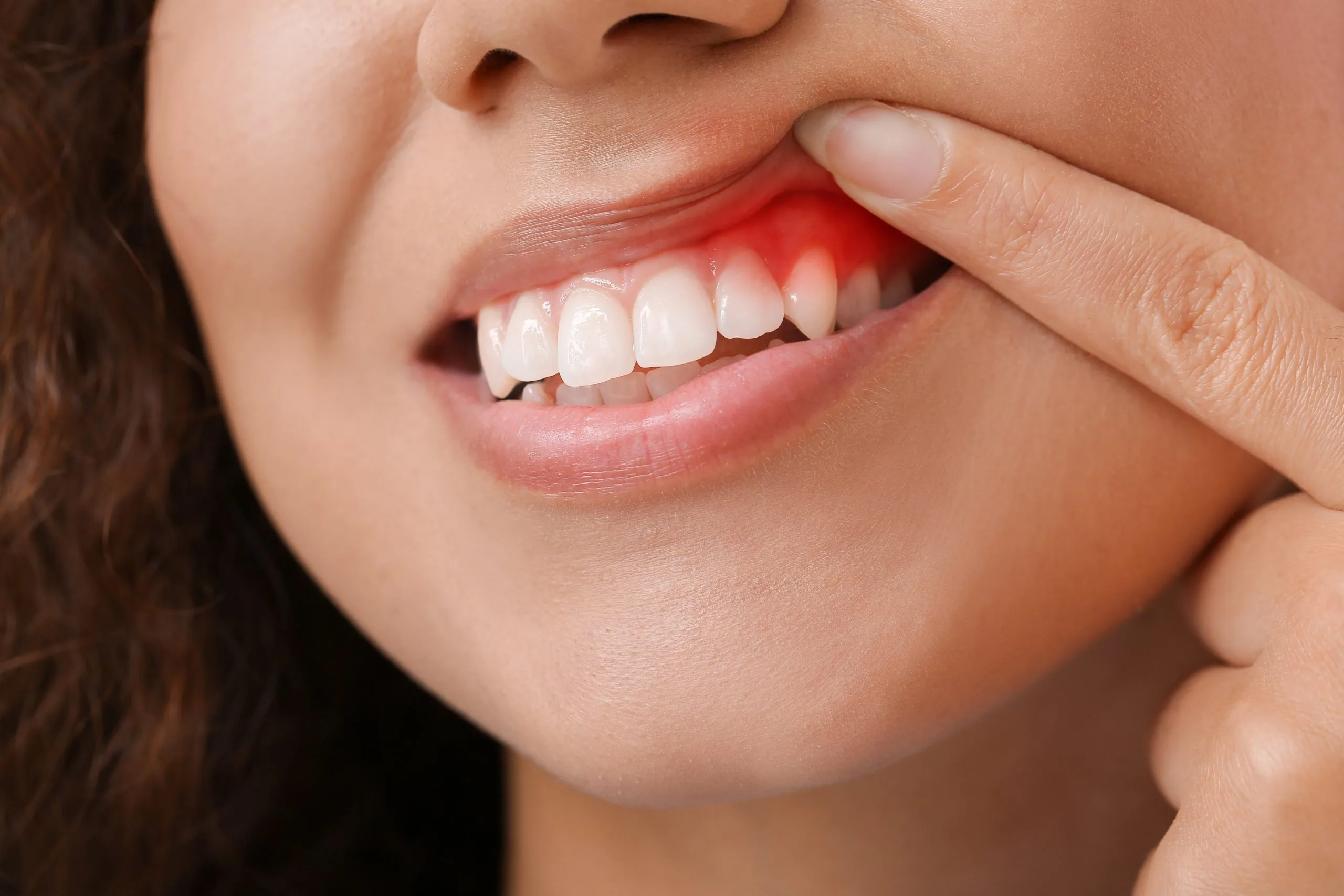 Frau zeigt auf gesundes Zahnfleisch – Smilezone Zug bietet professionelle Zahnfleischpflege und Parodontitisbehandlung.