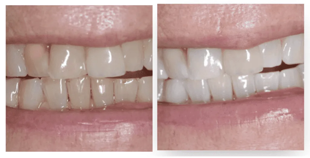 Before/after teeth comparison after bleaching treatment at Smilezone dentist Zug.