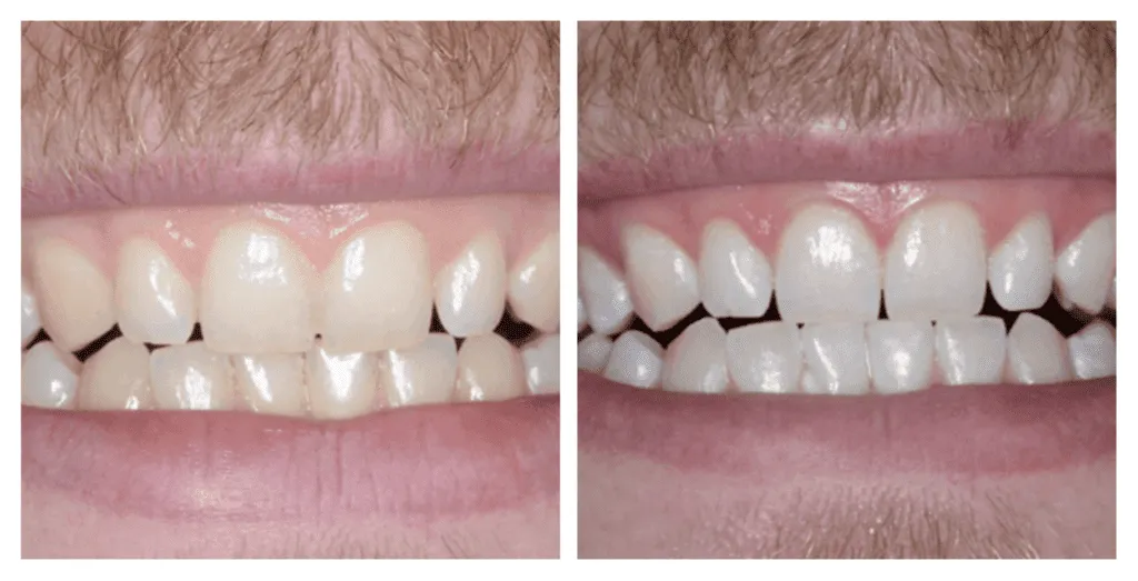 Before/after teeth comparison after professional bleaching at Smilezone dental practice Zug.