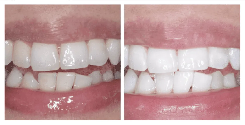 Before/after teeth comparison after bleaching treatment at Smilezone in Zug.