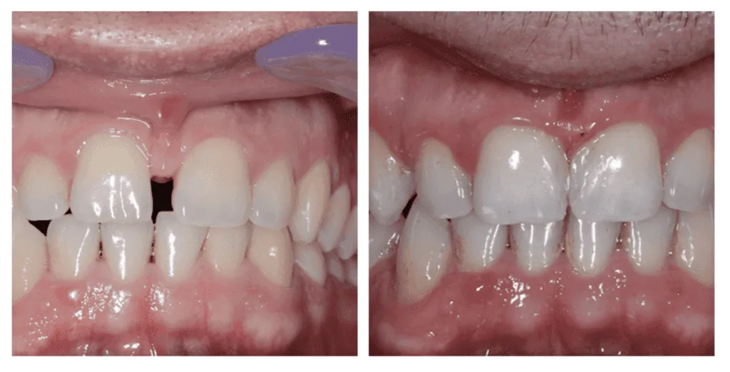 Vorher-Nachher-Vergleich einer Invisalign Zahnspange Behandlung bei Smilezone in Zug