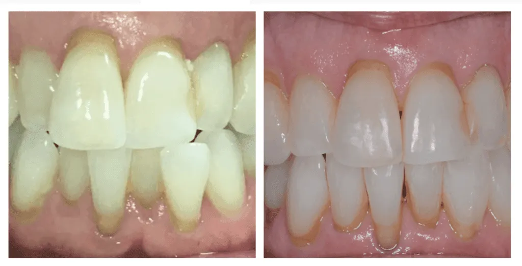 Vorher-Nachher-Vergleich von Zähnen nach einer Invisalign Behandlung bei Smilezone in Zug