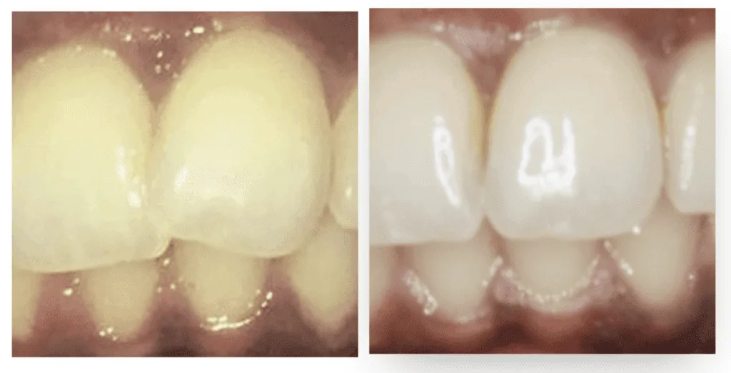 Vorher-Nachher-Vergleich von Zähnen nach einer Invisalign Behandlung bei Smilezone in Zug