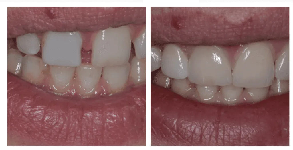 Vorher-Nachher-Vergleich von Veneers Behandlung in der Zahnarztpraxis Smilezone Zug