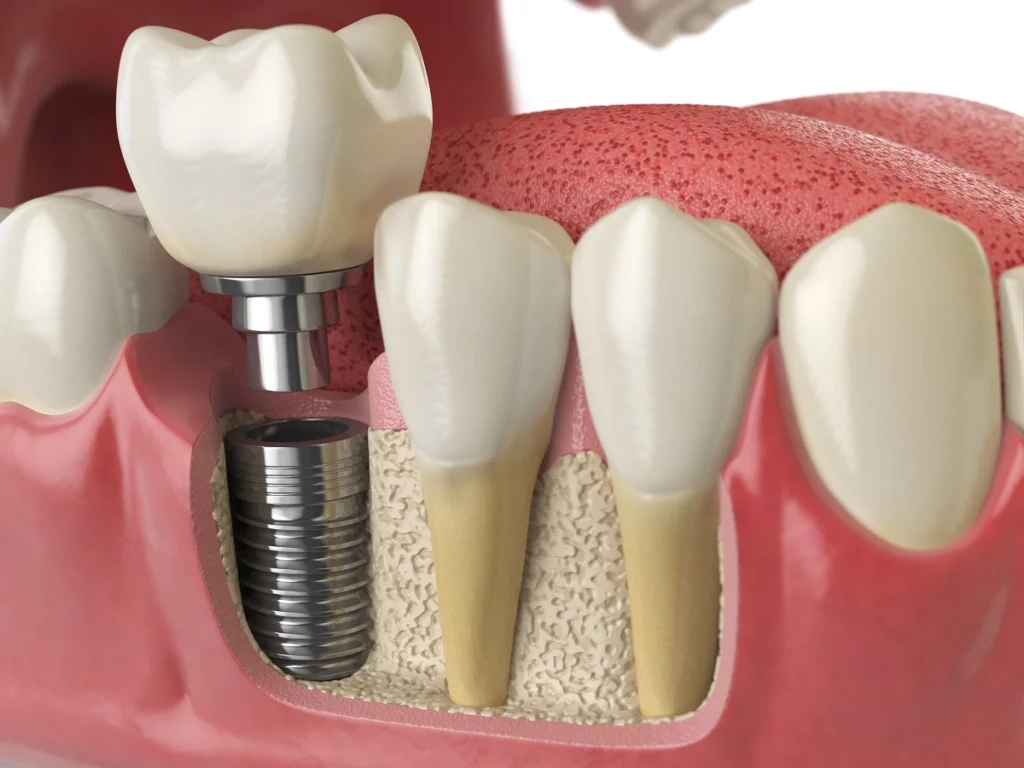 3D-Darstellung eines Zahnimplantats im Kiefer – Smilezone Zug bietet sanfte Implantat-Behandlung mit transparenten Kosten.