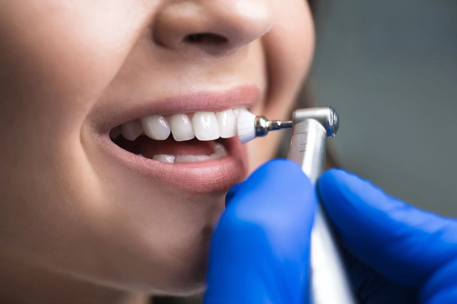 Professional dental hygiene treatment for healthy teeth at Smilezone Zug practice.