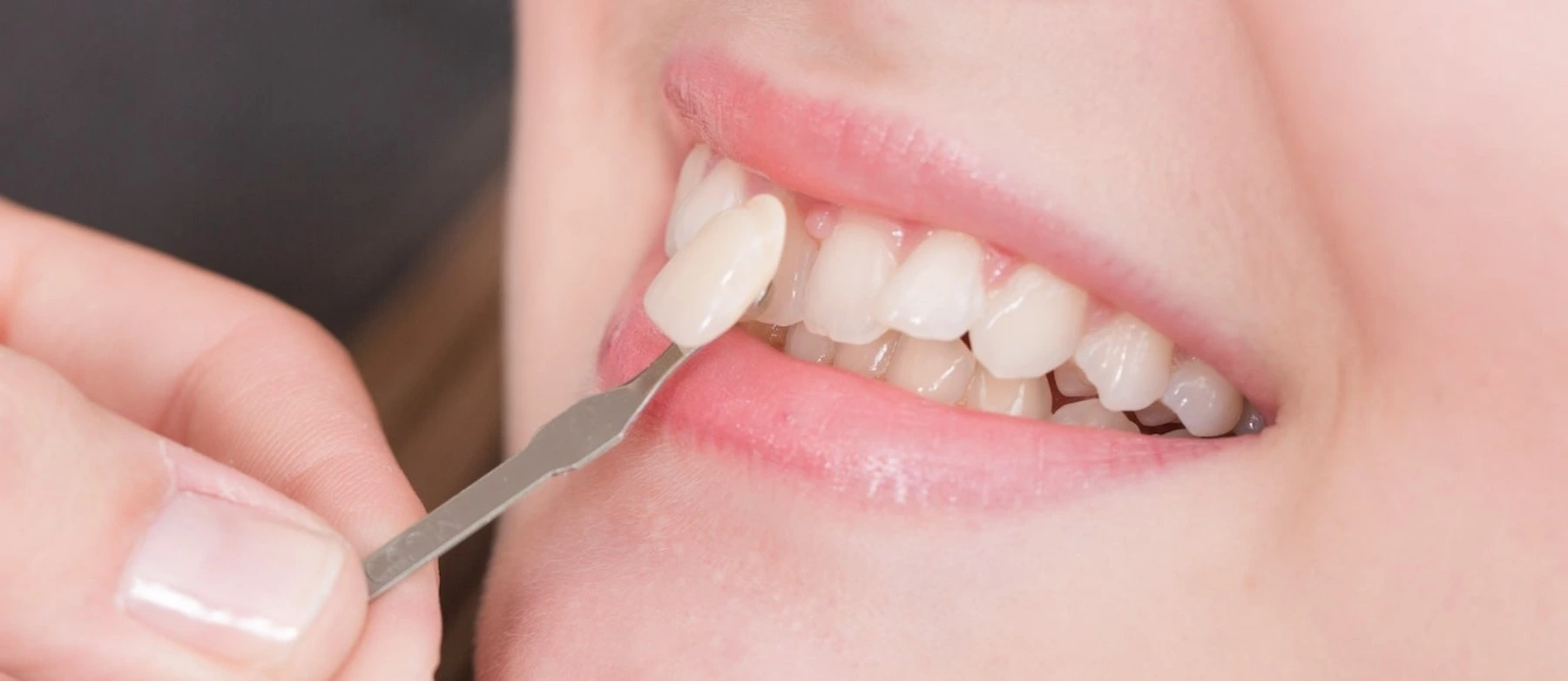 Zahnärztin setzt hauchdünnes Veneer auf Zahn – Smilezone Zug bietet hochwertige Keramikschalen für ein strahlendes Lächeln.