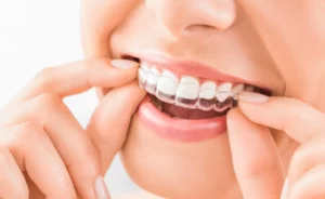 Woman inserts clear Invisalign aligner – invisible tooth correction at Smilezone Zug.