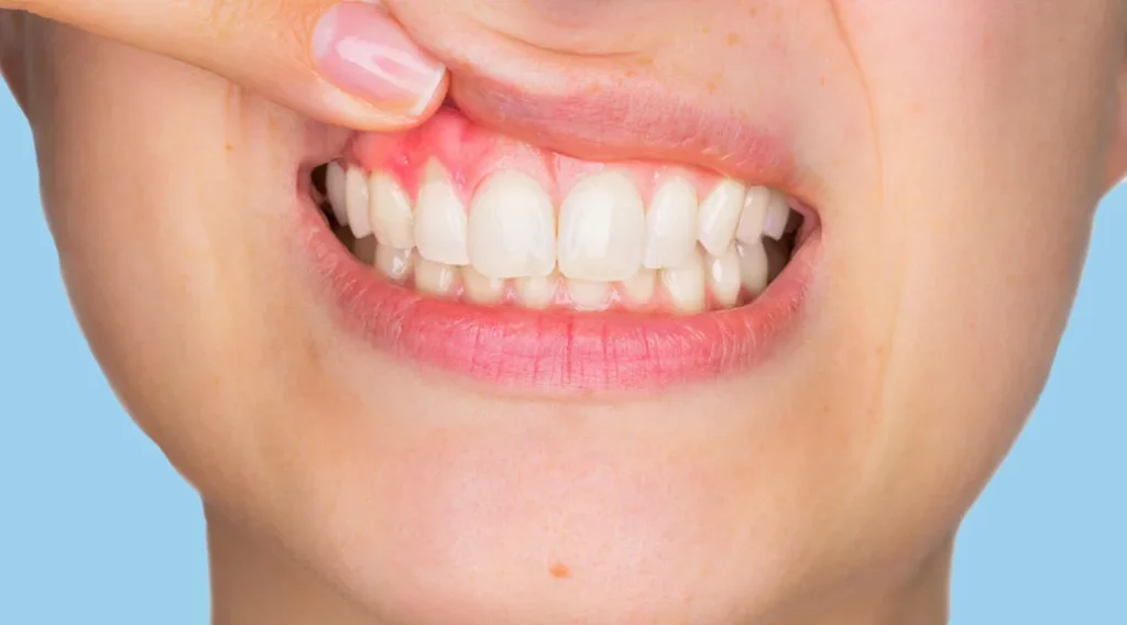 Zahnfleischrückgang und Zahnkronen Behandlung in der Zahnarztpraxis Smilezone in Zug