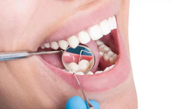 Dentist checking teeth with mirror during dental hygiene at Smilezone Zug.