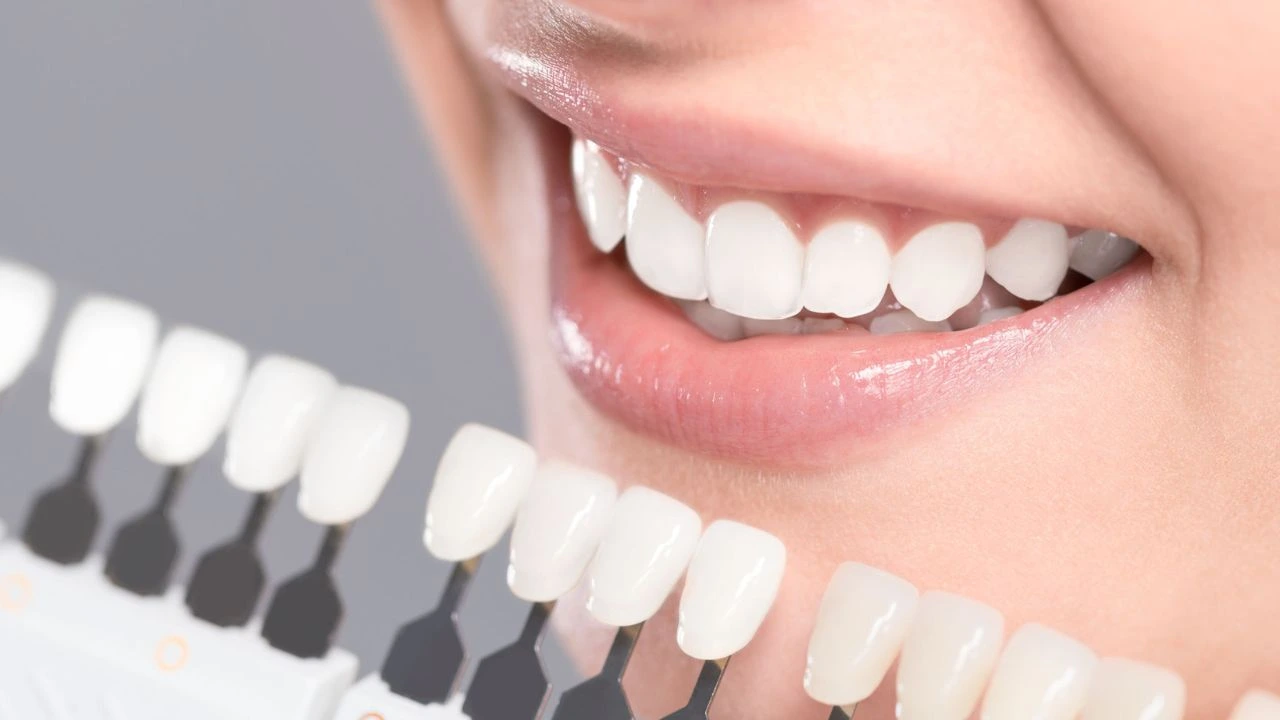Radiant white teeth after professional bleaching. Smilezone Zug for a beautiful smile.