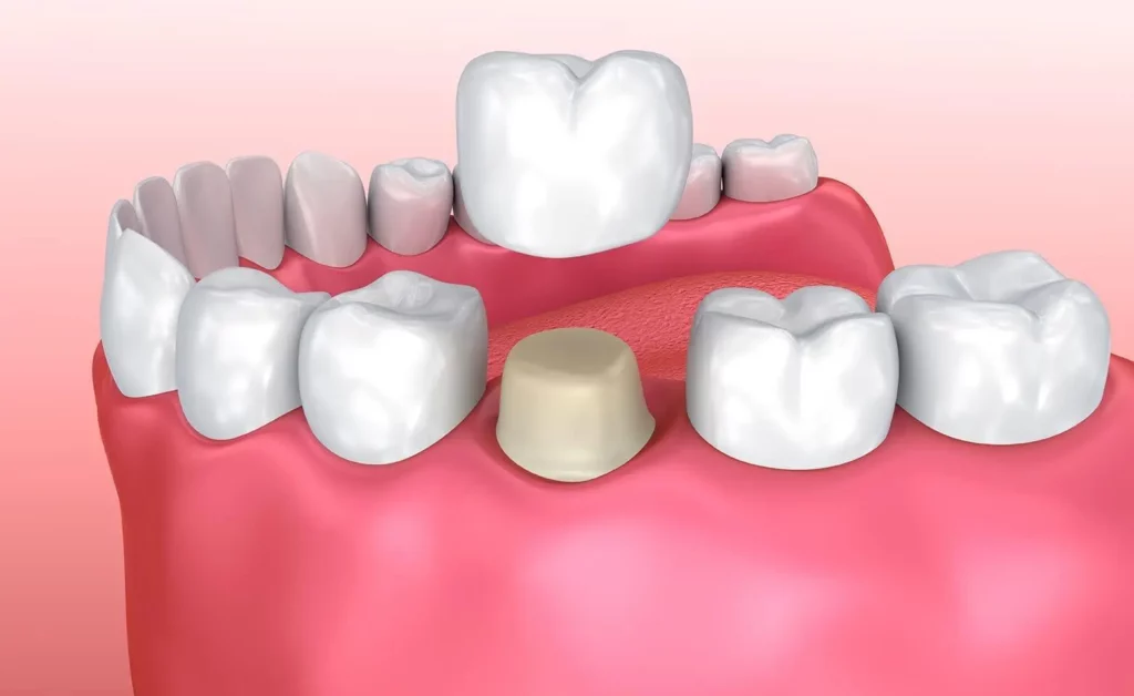3D-Illustration einer Zahnbrücke auf Implantaten – Smilezone Zug sorgt für stabile und natürlich aussehende Zahnrekonstruktion.