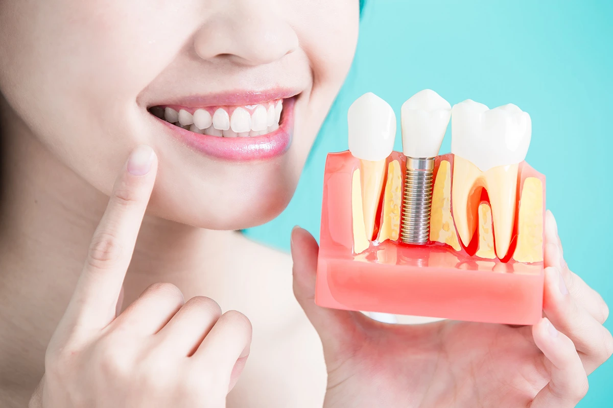 Frau lächelt und zeigt Modell eines Zahnimplantats von Smilezone Zahnarzt Zug