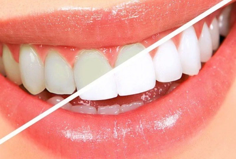 Before/after teeth whitening comparison at Smilezone, your dentist in Zug.