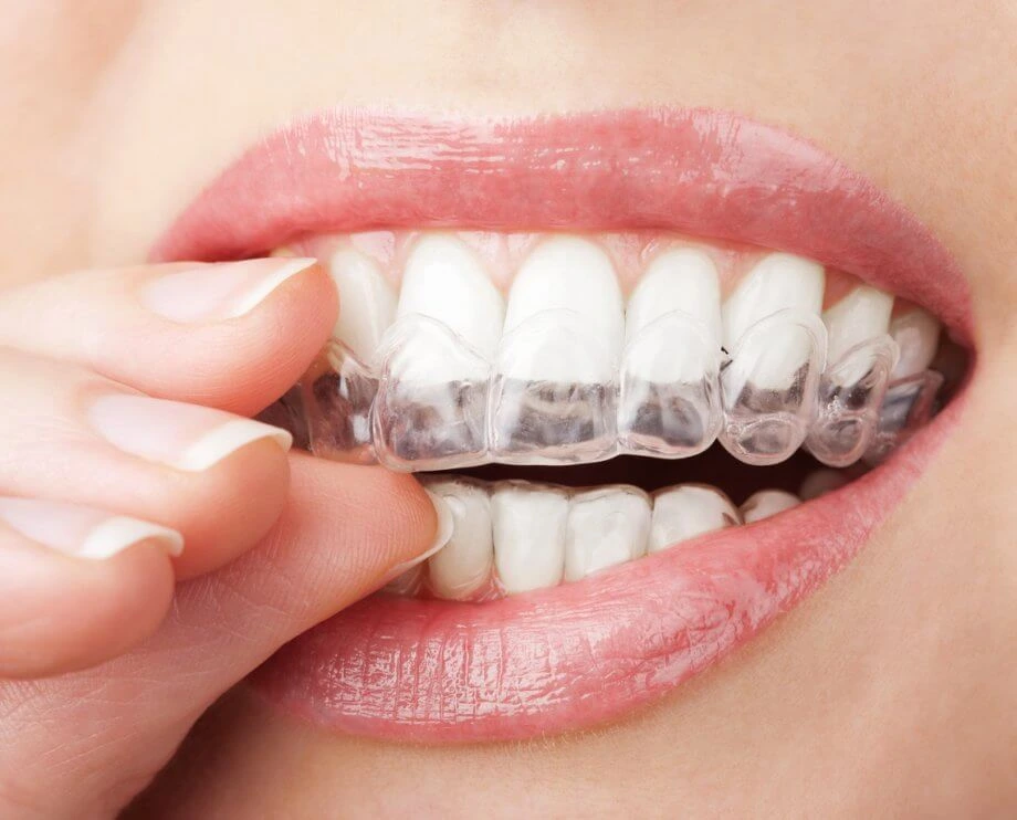Woman inserts Invisalign aligner. Smilezone dental practice in Zug offers this.