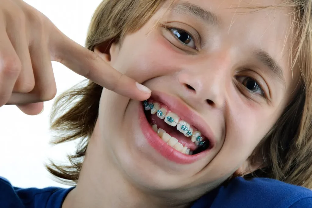 Kind lächelt mit bunter Zahnspange – Kinderspangen Behandlung für gerade Zähne bei Smilezone Zug.