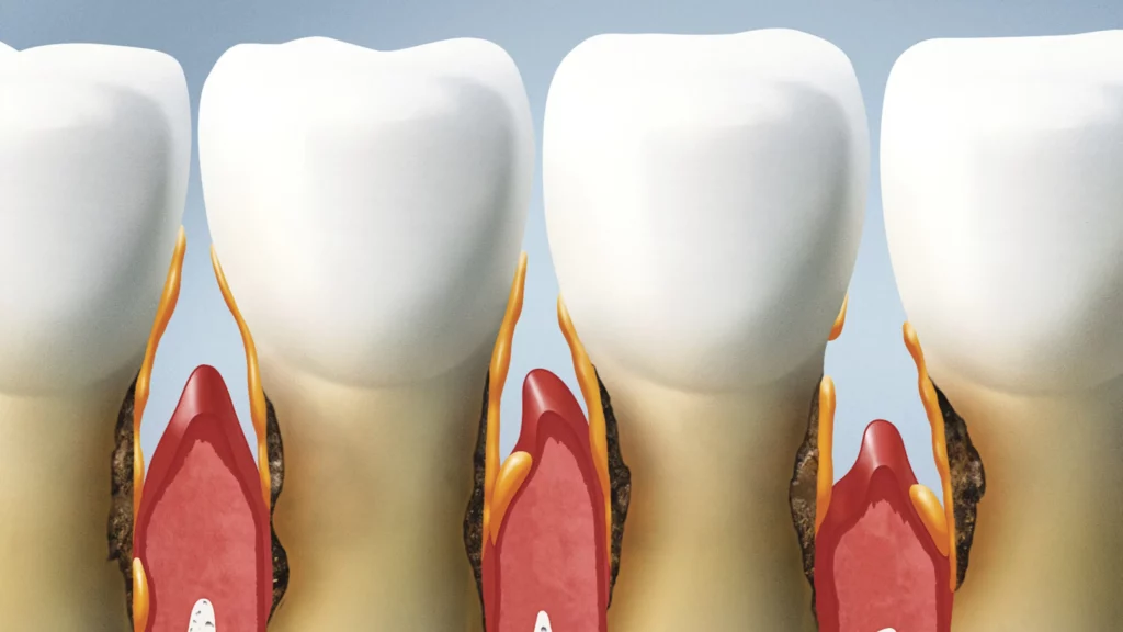 Grafische Darstellung von gesundem und entzündetem Zahnfleisch – Smilezone Zug behandelt Parodontitis und Zahnfleischrückgang effektiv.