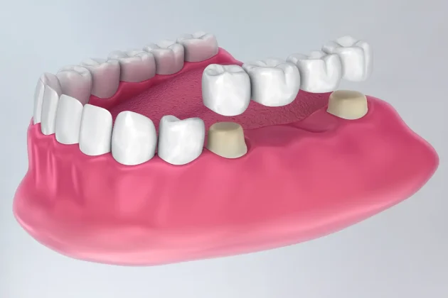 Zahnbrücke zur Schließung einer Zahnlücke – Smilezone Zug bietet ästhetische und funktionale Lösungen für fehlende Zähne