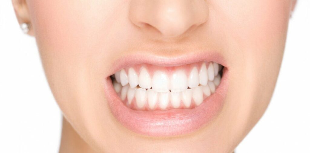 Woman clenching teeth; Smilezone Zug offers splints for teeth grinding protection.