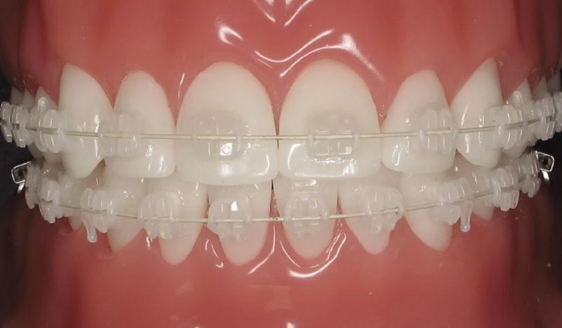Transparentes Aligner System zur sanften Zahnkorrektur bei Smilezone