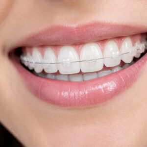 Lächelnder Mund, gerade Zähne mit weissen Keramik-Brackets und dünnem Draht